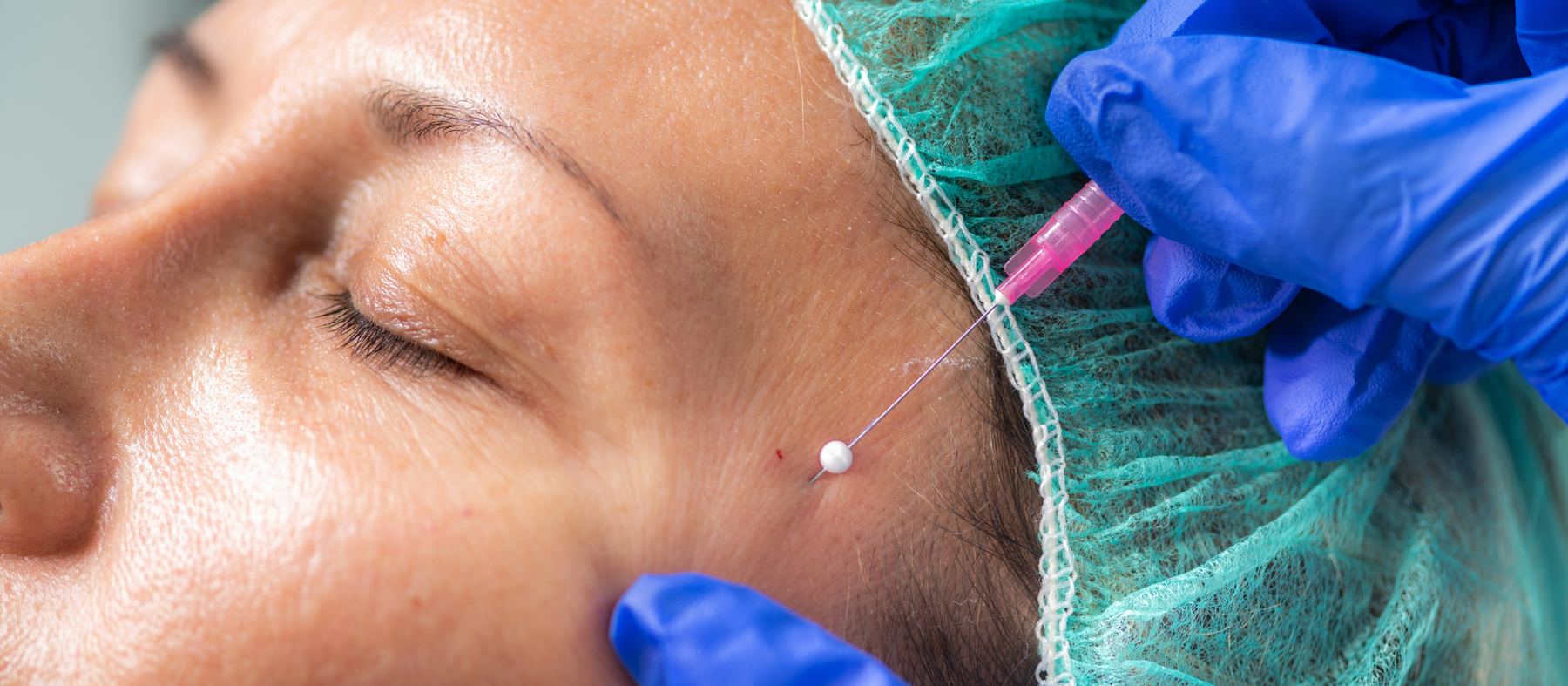 Injectable anti-wrinkle treatment being administered by a registered nurse