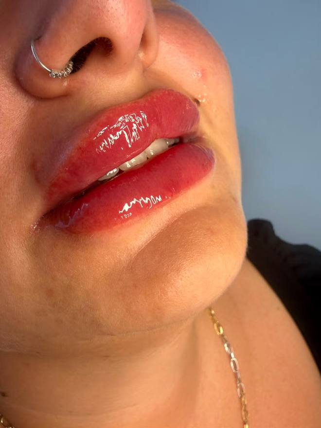 Natural lip enhancement result with dermal filler at Novel Aesthetics, Chelmsford