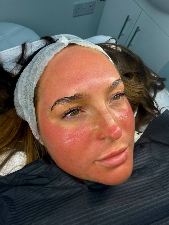 Client immediately after a microneedling treatment showing normal short-term redness